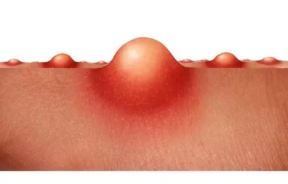 老中医的清痘手法,老中医治痘的方子