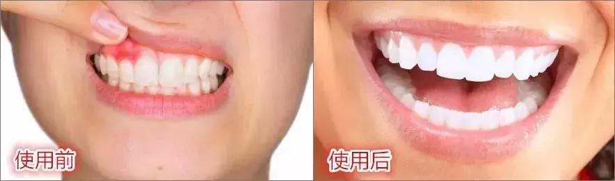 一口黄牙影响颜值,一口黄牙齿