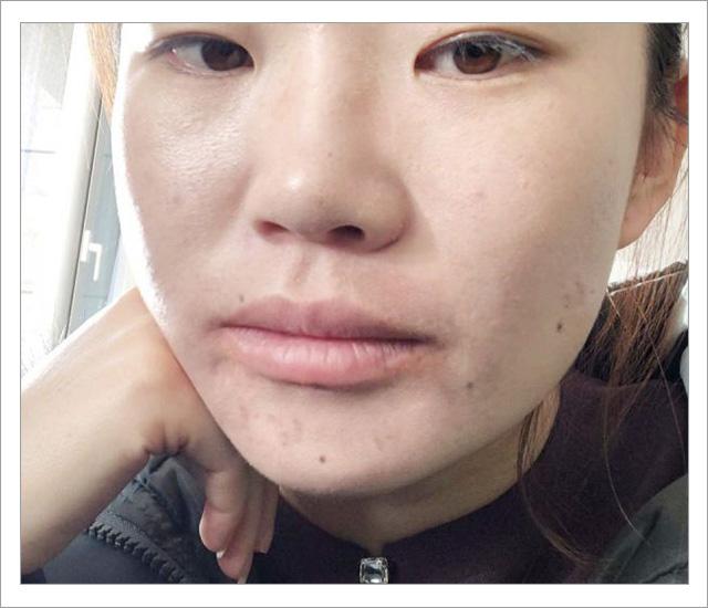 脸上螨虫的正确消灭方法,脸上的螨虫能不能彻底消灭