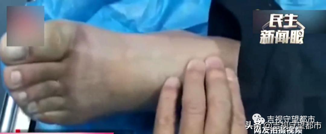 大连一男子聚餐后醉酒冻僵截肢了,男子醉酒躺路边冻僵