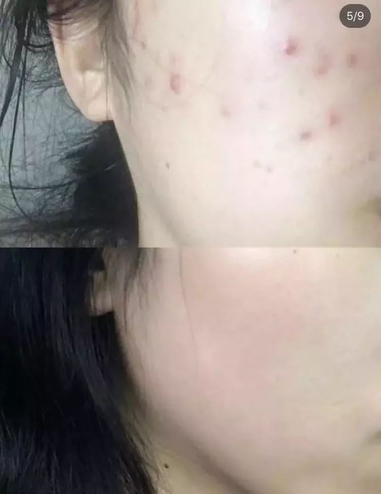 脸上螨虫多出油厉害怎么办,脸上螨虫过敏烂脸