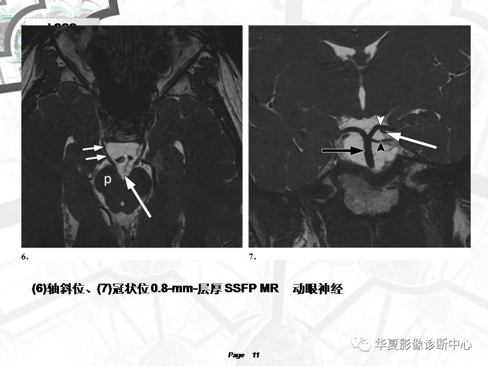 磁共振颅神经扫描是定位在哪,颅神经图谱