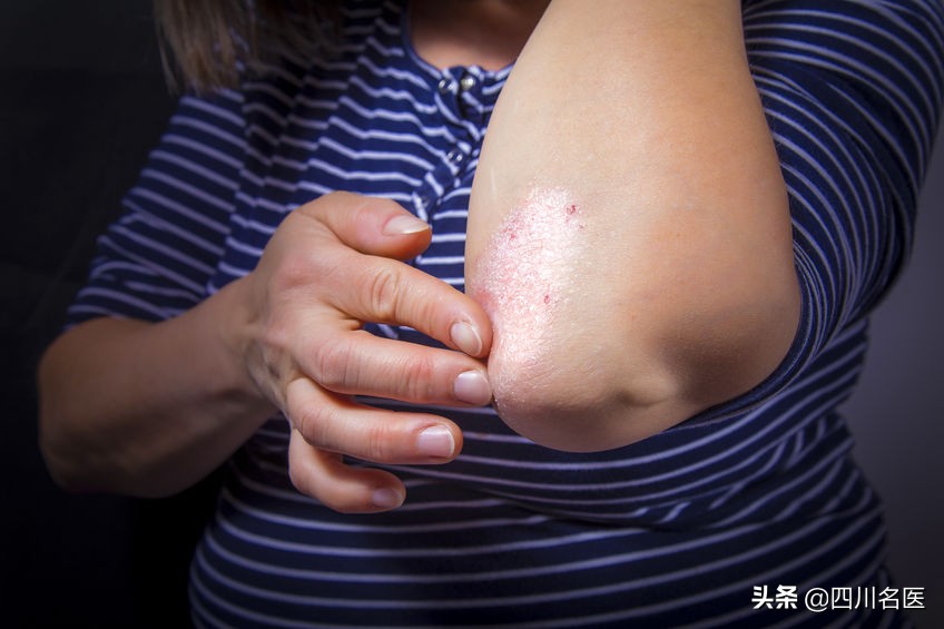 银屑病全身红疹,银屑病红疹越多越容易好
