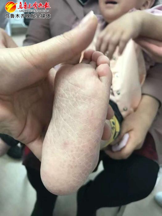 小孩子身上长蛇皮癣,两岁男孩身上长癣