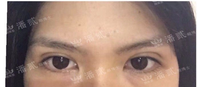 全切双眼皮提肌失败还能修复吗,什么是失败的双眼皮