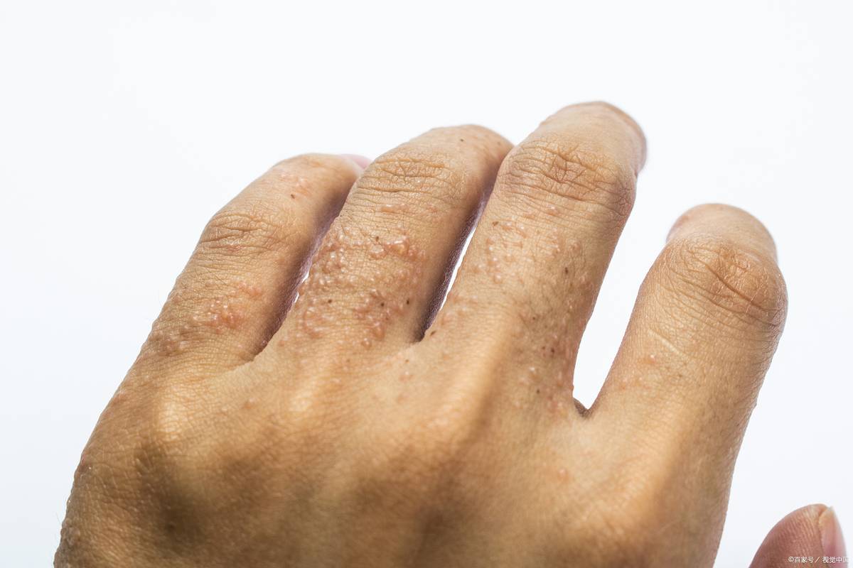 湿疹痒如何忍住不挠,脚湿疹痒挠不愈合