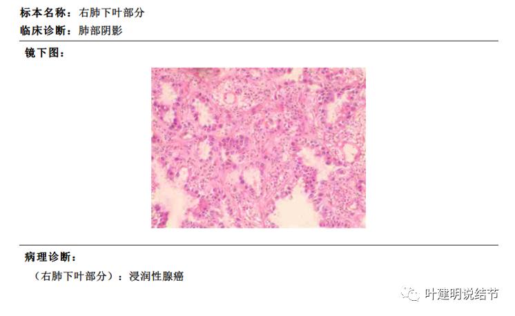 左肺癌手术半年右肺下角还有炎症,左下肺癌晚期