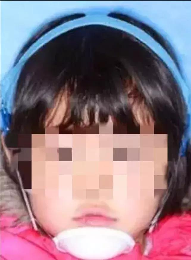 什么叫地包天怎么治疗,什么叫地包天能矫正吗