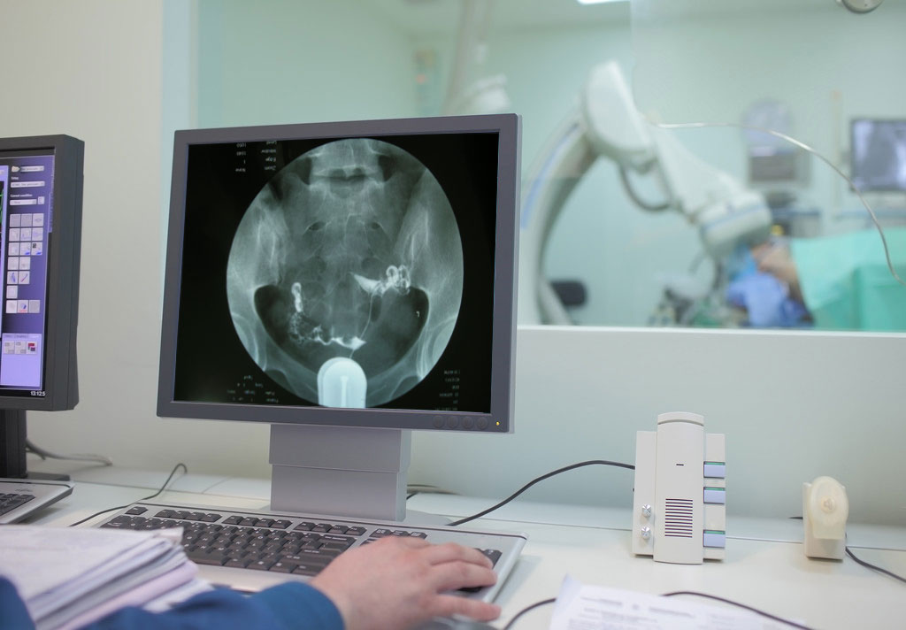 4步讲解输卵管造影检查过程