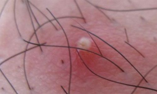 毛囊炎症状如何治疗,怎么预防痤疮毛囊炎加重