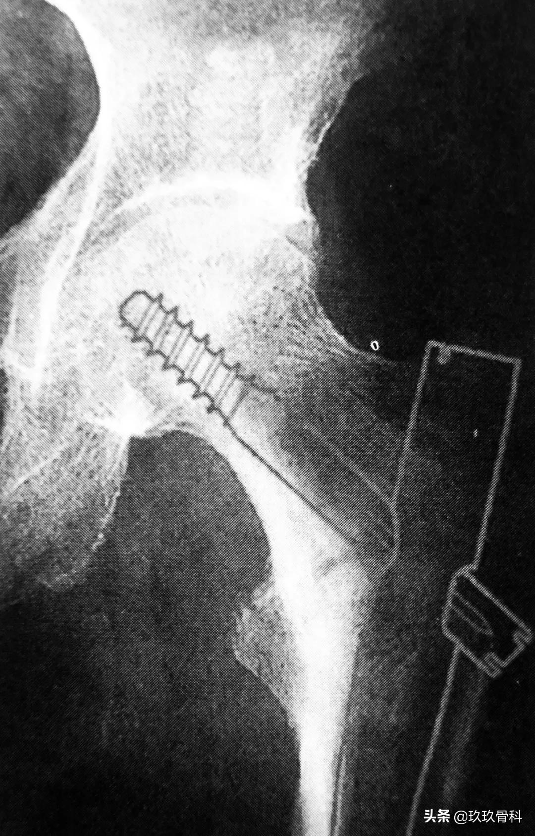 骨科取髓内钉的视频,骨科髓内钉内固定术式简写