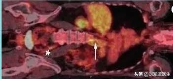 「免疫相关不良妊娠答疑解惑40」——系统性血管炎