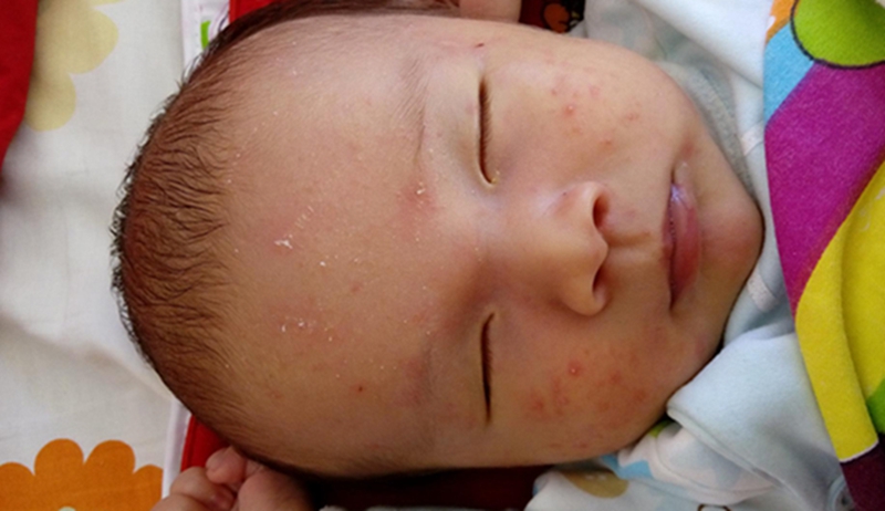 月嫂怎样解决宝宝湿疹问题,宝宝湿疹有妙招月嫂分享