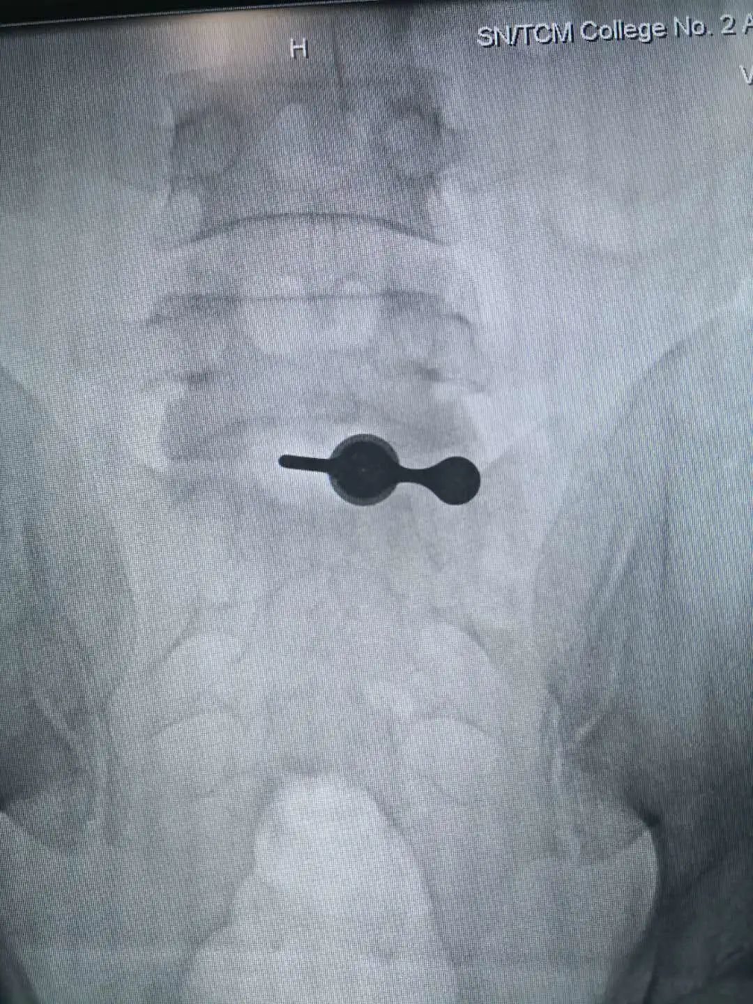陕西椎间孔镜手术最好的医院,椎间孔镜手术陕西哪个医院做得好