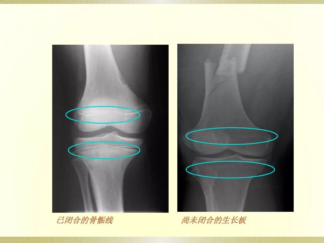 骨科x光片读片技巧,放射科骨科读片教程