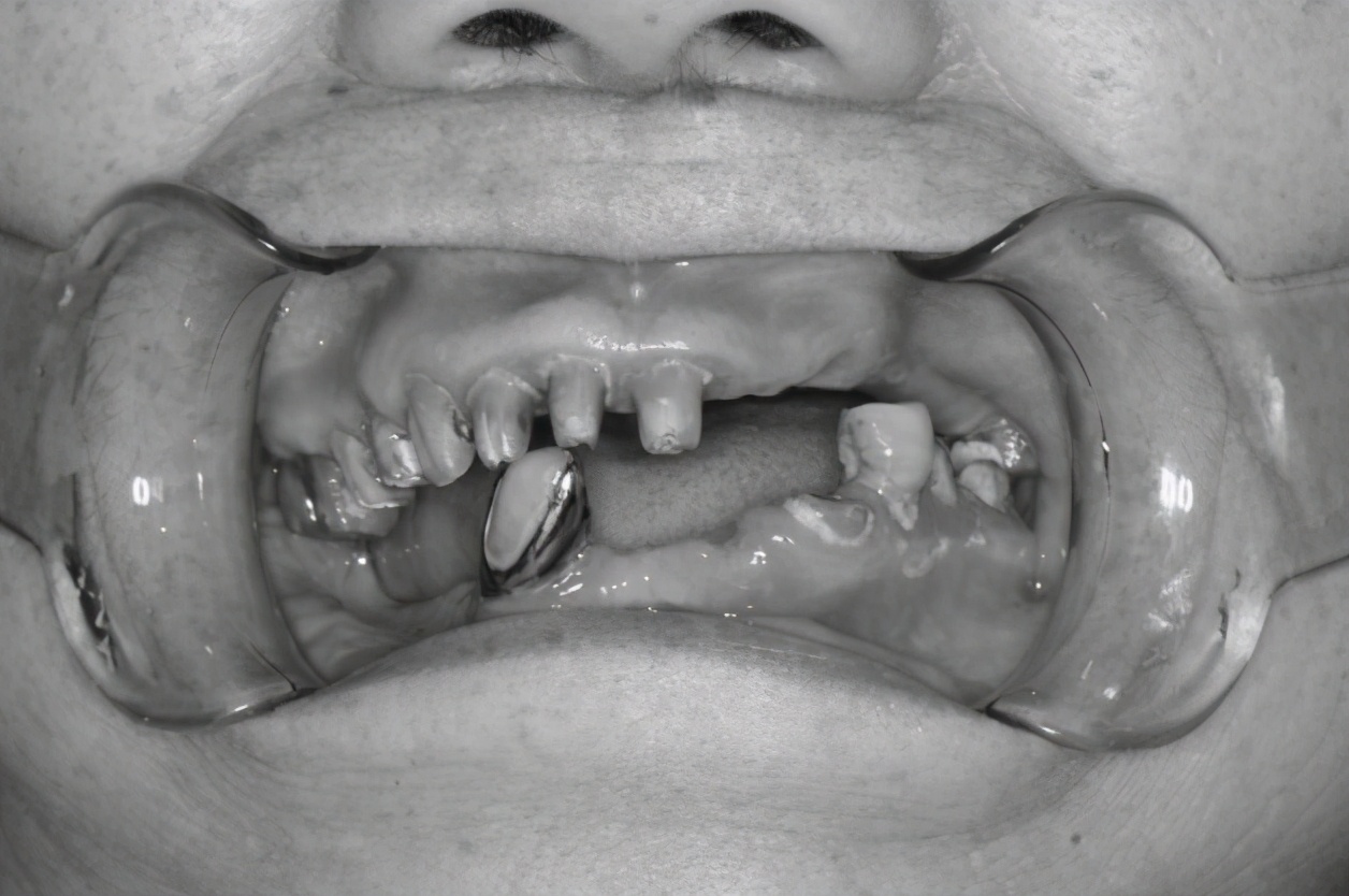 女子吃饭牙掉了原视频,吃骨头大牙崩掉一块