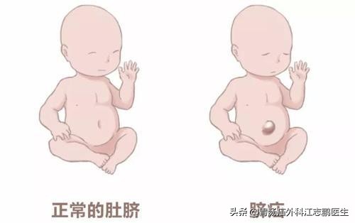 脐疝是什么意思呀,科普脐疝