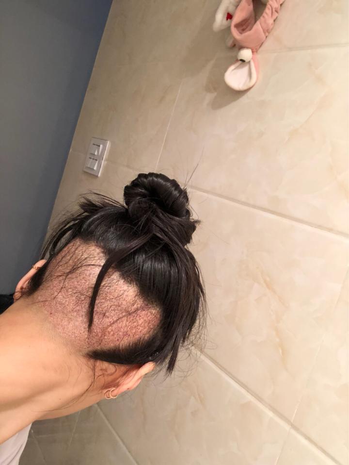 植发必须要理光头吗？