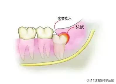 智齿很小一个自己就拔掉了,稍微晃动的智齿拔掉很快吗