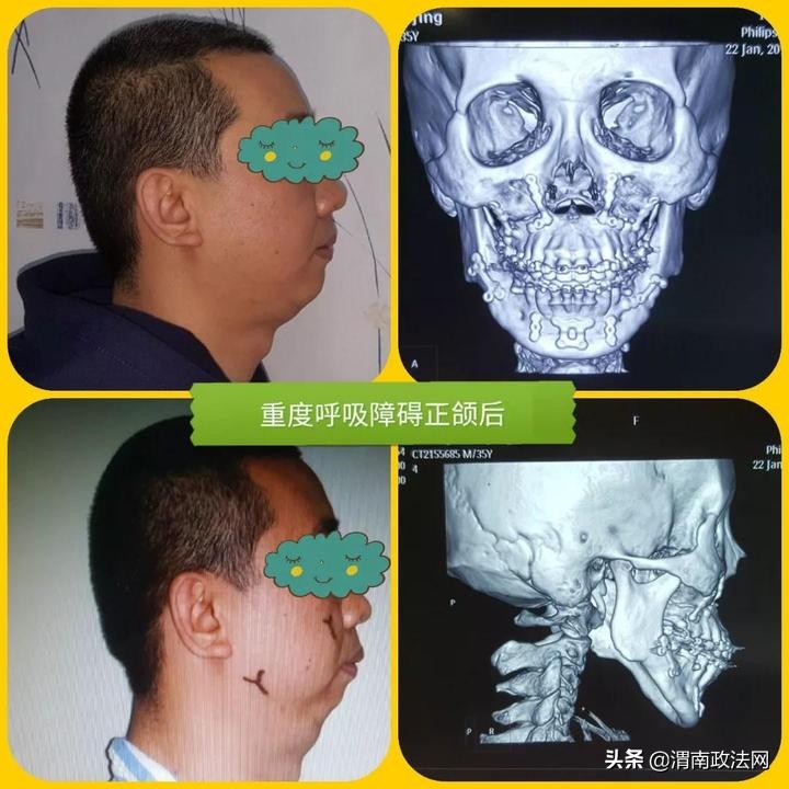 从小打呼变“鸟嘴”，大学老师为睡个好觉锯断下巴