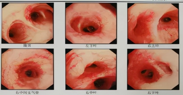 感觉身体淋巴结游走性疼痛,全身多处炎性淋巴结