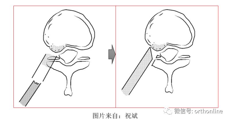 胸椎怎么做微创,脊柱内镜微创操作流程