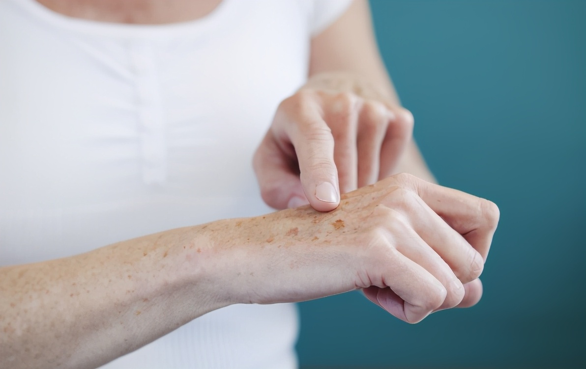 身上老年斑怎么可以去除,30岁身上长老年斑消除最好的方法