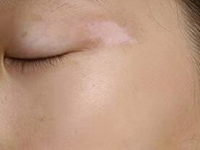 皮肤上长白癜风应该怎么治?稳定期的白癜风治疗用什么方法好?