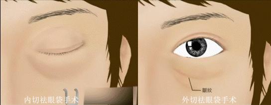 分享祛眼袋我的真实经历,关于祛眼袋你一定有好多疑问