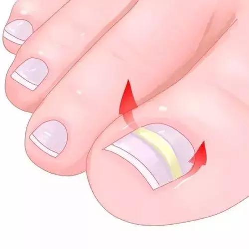 足疗店灰指甲治疗费用大概多少钱,得了灰指甲一个传染俩靠谱吗