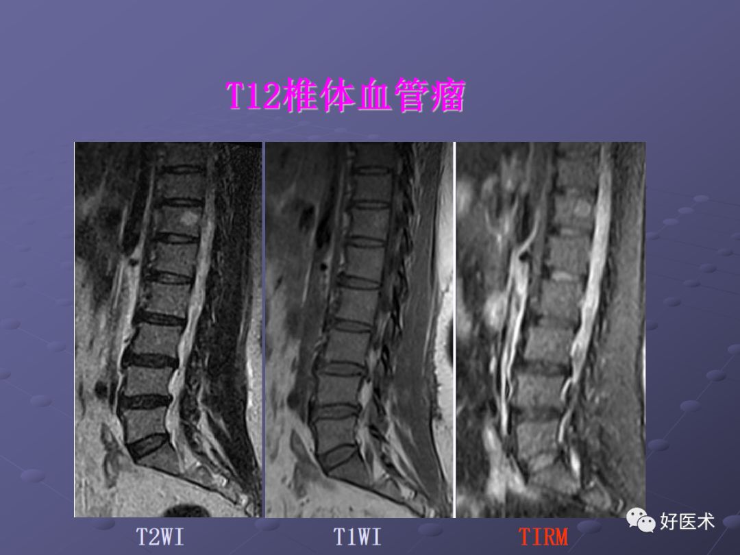 脊柱mri有哪些特点,乳腺疾病的mri诊断及鉴别