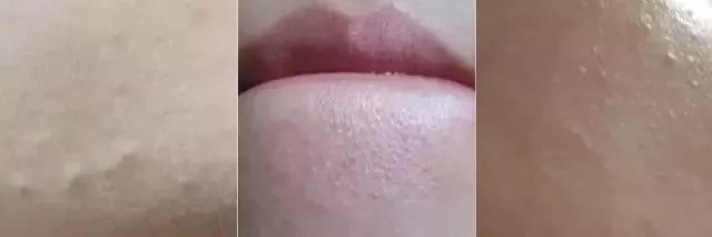 满脸都是闭口,满脸都是闭口的状态