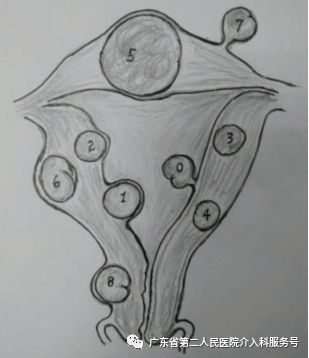 子宫肌瘤引起“大姨妈”排山倒海，淋沥不净……针眼妙方解除烦恼