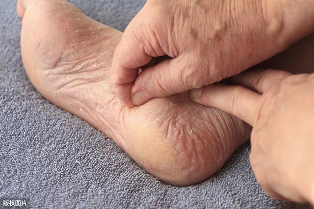 怎样才能简单让臭脚去臭,现在治脚臭的办法