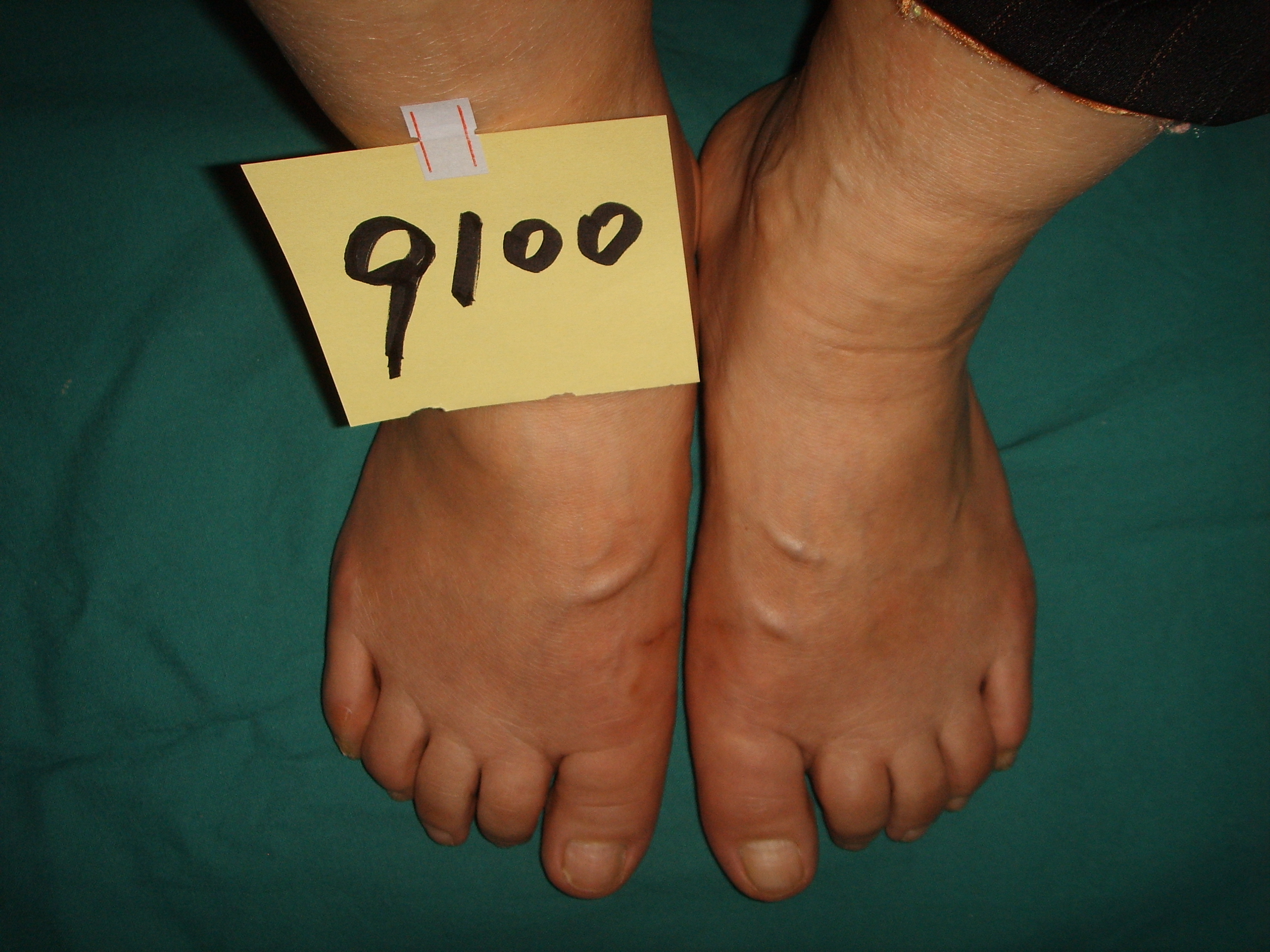 女性大脚骨图片大全,女士大脚骨