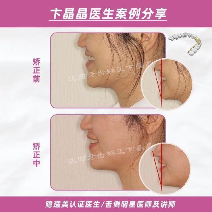 隐适美牙套矫正过程,隐适美个别牙反颌矫正真实案例