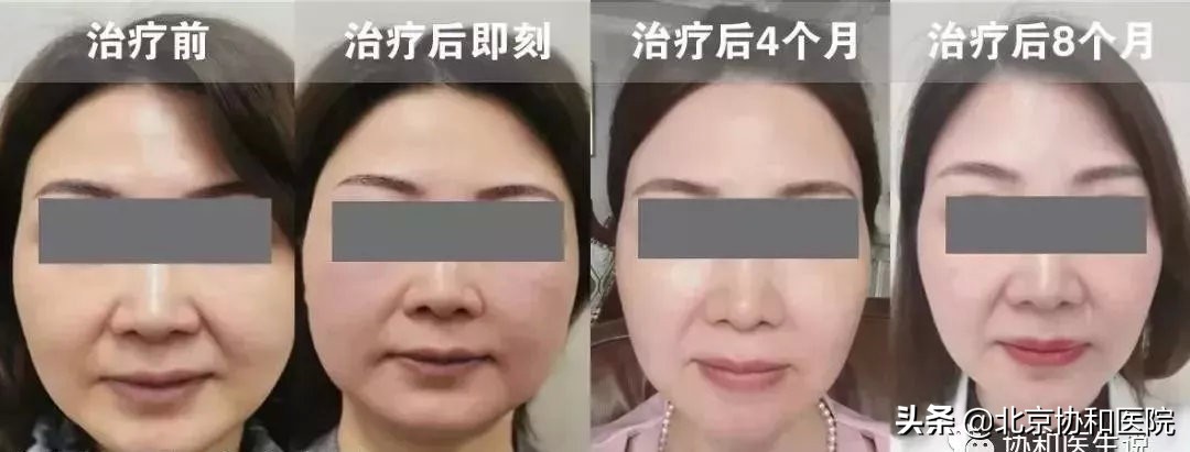 40岁女性适合的身体整形医美项目,40岁的女人整形手术