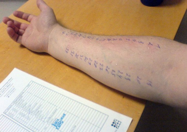 宝宝过敏体质怎么判断严重程度,宝宝过敏体质怎么判断