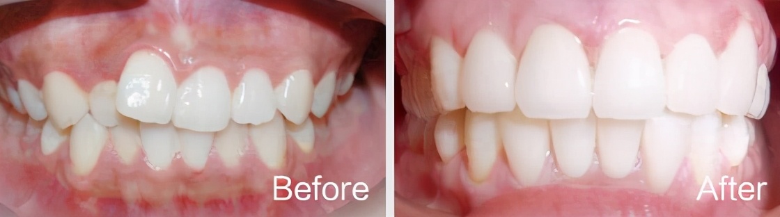牙齿矫正牙套丢了怎么办,牙齿矫正过程中怎么防止牙套松