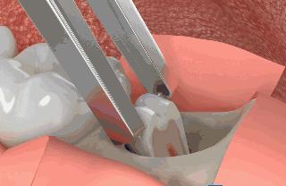 拔牙打麻药大脑是清醒的吗,拔牙打麻药会不会影响恒牙