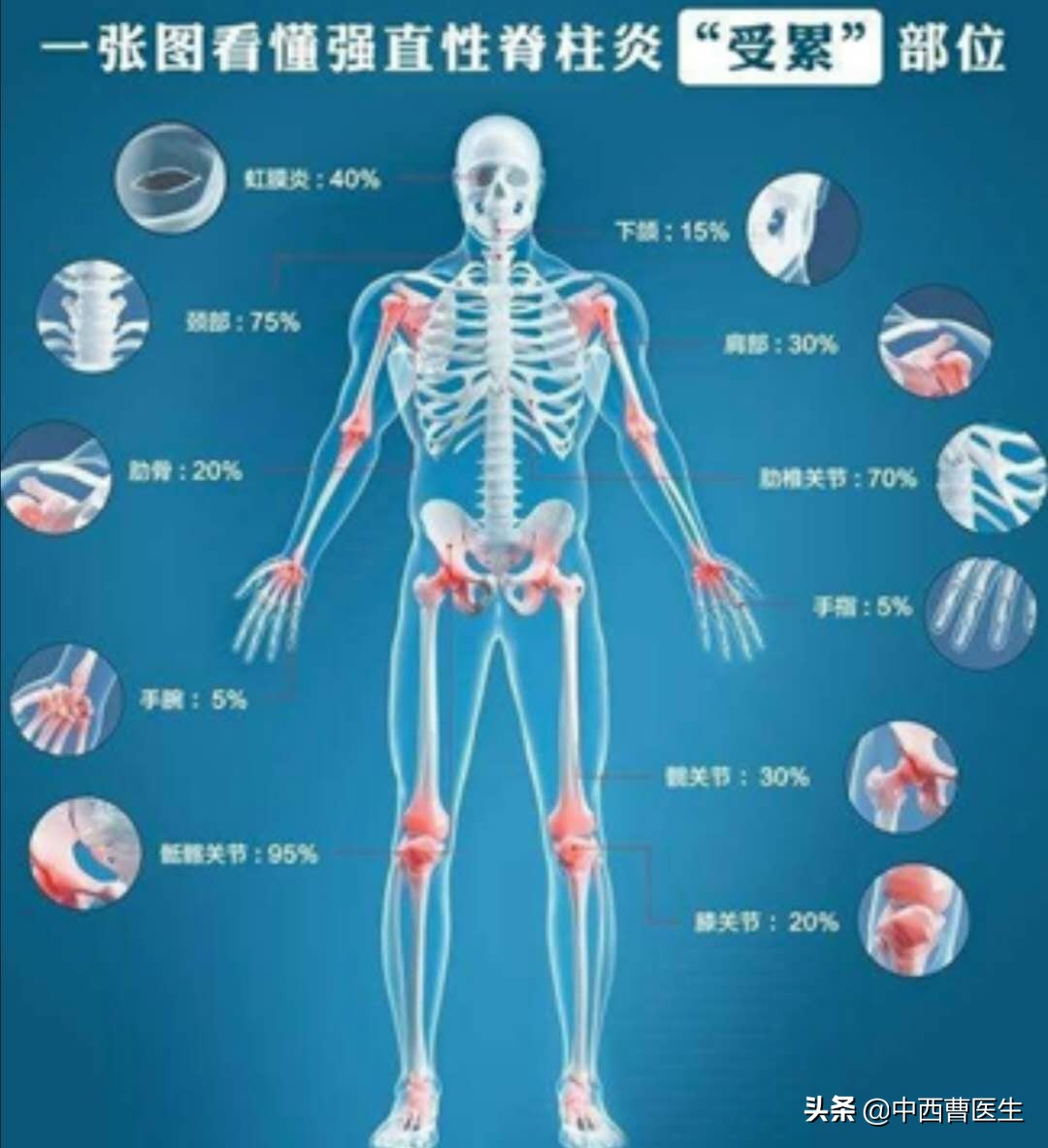 什么是强直性脊柱炎症状是什么,什么是强直性脊柱炎如何治疗