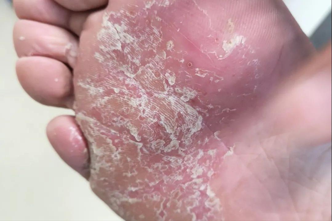 脚上真菌感染脱皮干裂怎么办,脚上脱皮又痒是真菌感染