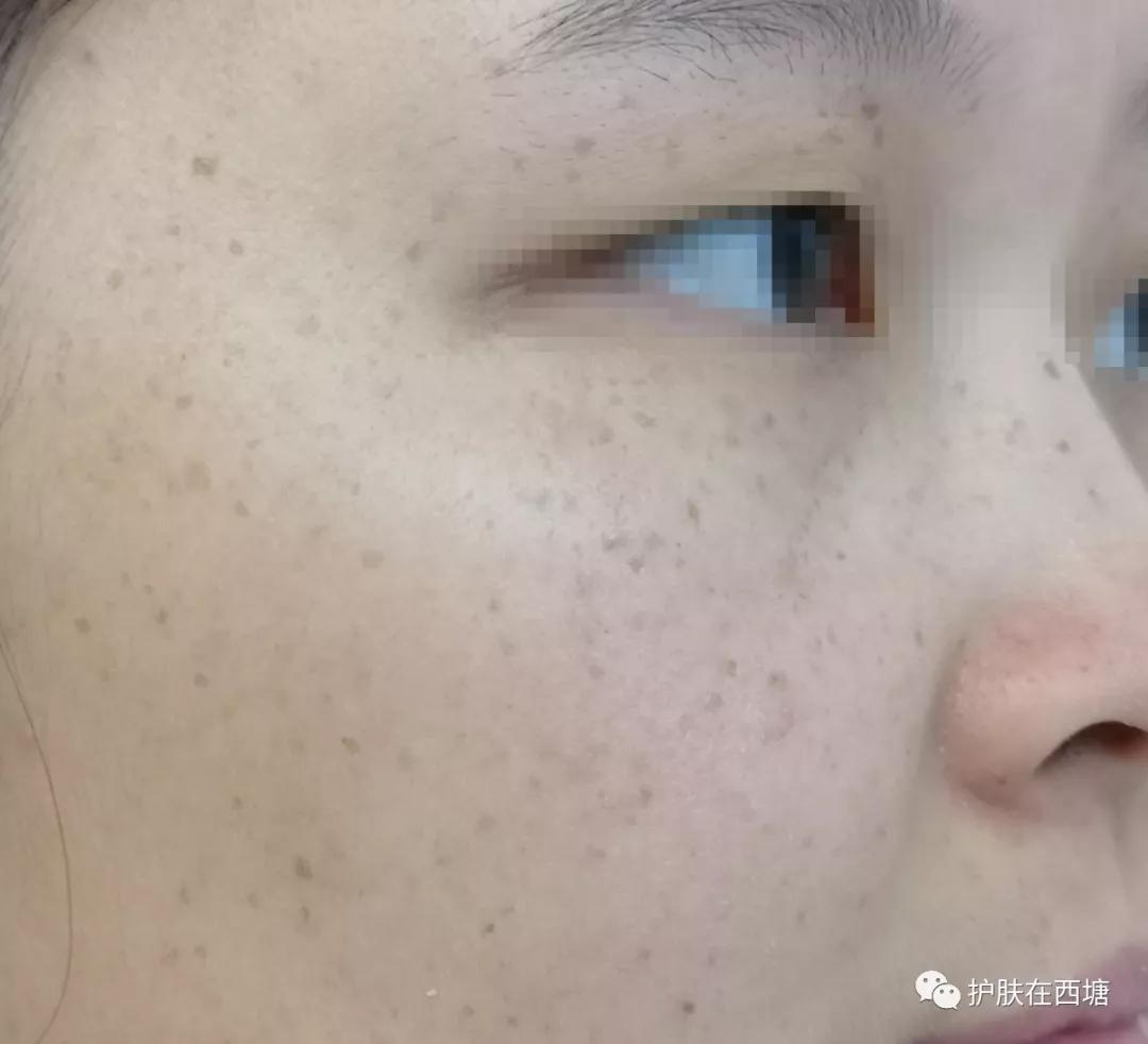 祛斑内调好还是外用好,冬季祛斑正确用法