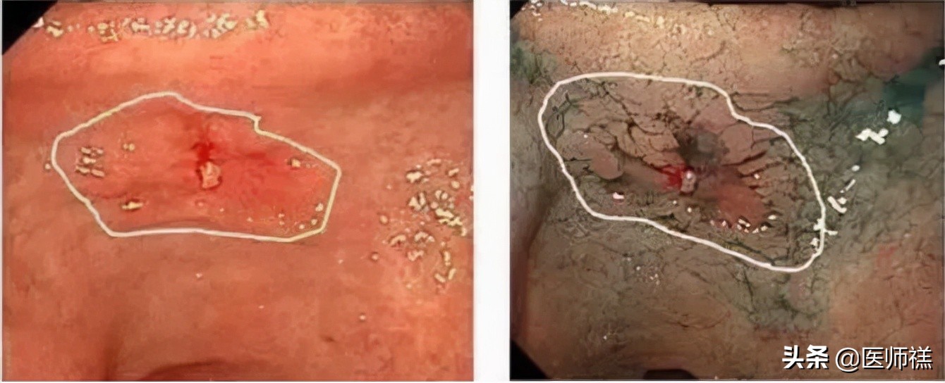 胃炎久治不愈查肿瘤标志物正常,胃炎一直拖着不治
