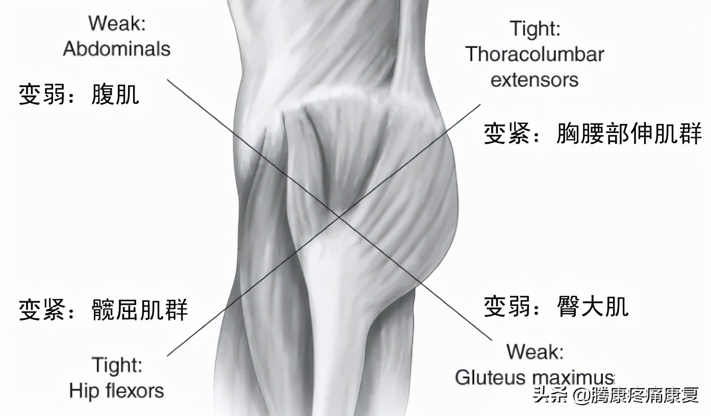 怎么解决下交叉综合症,下交叉综合征改善训练