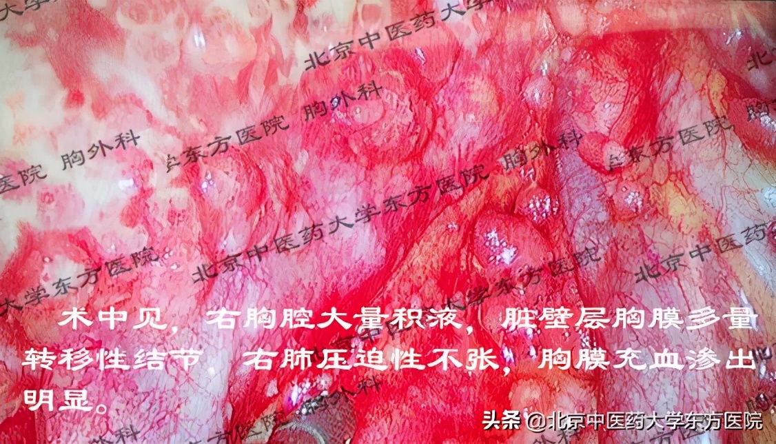 北京治疗胸腔积液哪个医院权威,中医治疗心脏胸腔积液