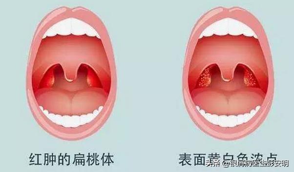 45岁男摘除扁桃体有什么危害,41岁扁桃体切除后后遗症