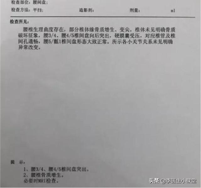 腰间盘突出症，除了药物治疗，康复锻炼是否可行？怎么做才正确？