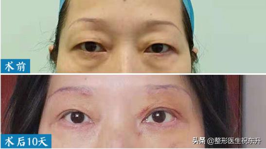 当你老了，上眼皮松了，其实恢复年轻并不难...