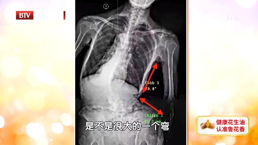 腰椎其中一节变形最好的治疗方法,腰椎轻度变形怎么治